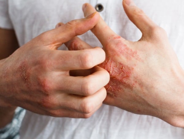 Suffer From Eczema? A New Medication May Help