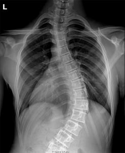 22257695 scoliosis optimum life health c 246x300 1